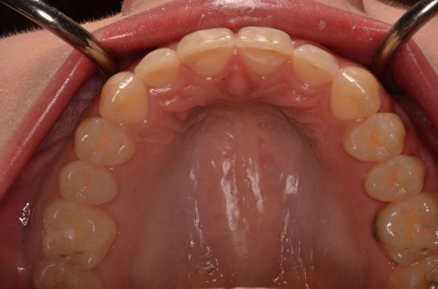 Invisalign: Case 11 - After orthodontics