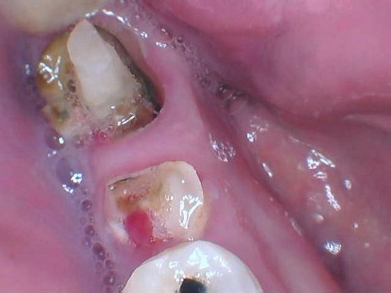 Dental Implants: Case 31 - Before severely decay and broken teeth were removed