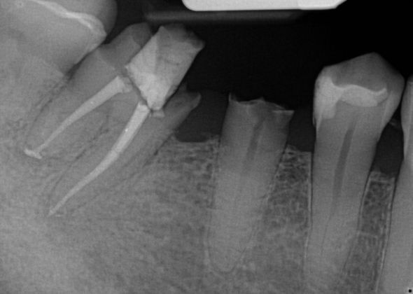 Dental Implants Case 31 - Before