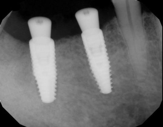 Dental Implants Case 31 - After