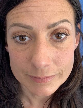 Rhinoplasty Case 20 Rhinoplasty, Norwalk, CT - Before