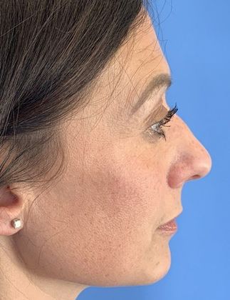Rhinoplasty: Case 20 Rhinoplasty, Norwalk, CT - Before