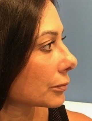 Rhinoplasty: Case 20 Rhinoplasty, Norwalk, CT - After