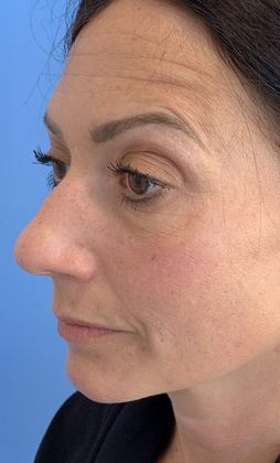 Rhinoplasty: Case 20 Rhinoplasty, Norwalk, CT - Before