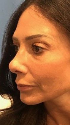 Rhinoplasty: Case 20 Rhinoplasty, Norwalk, CT - After