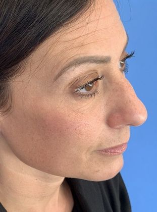 Rhinoplasty: Case 20 Rhinoplasty, Norwalk, CT - Before