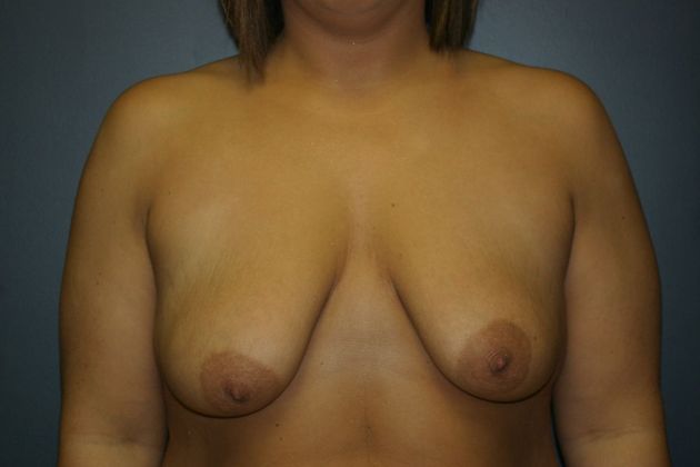 Breast Lift: Case 4 - Before