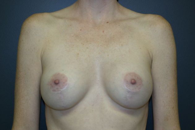 Breast Lift: Case 3 - After