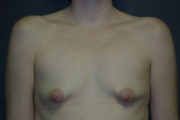 Breast Lift: Case 3 - Before