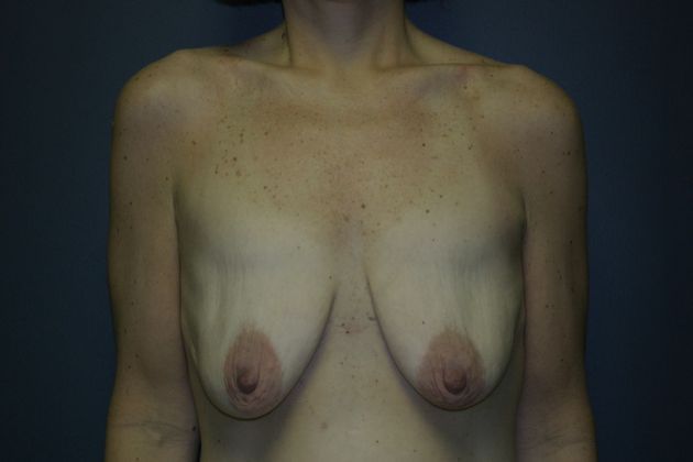 Breast Lift: Case 5 - Before
