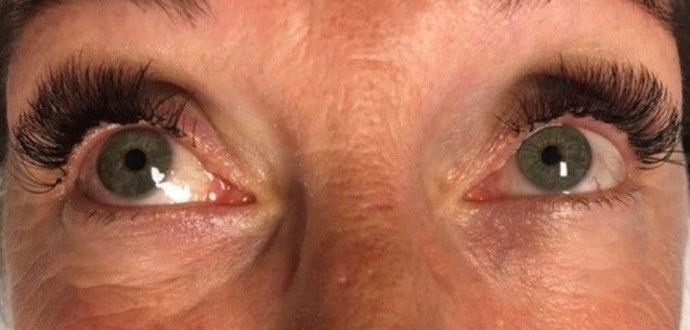 Cosmetic Tattooing: Eyeliner Tattoo - Before