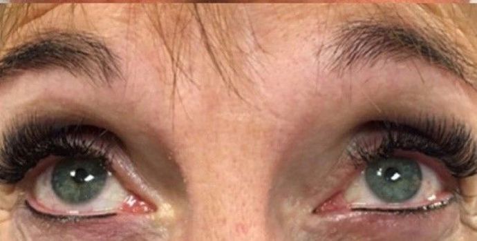 Cosmetic Tattooing: Eyeliner Tattoo - After