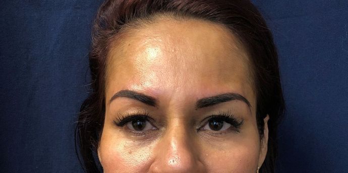 Cosmetic Tattooing: Cosmetic Brow Tattooing - After
