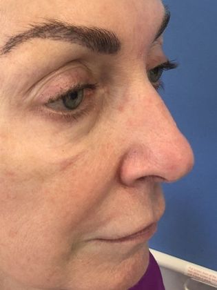 Rhinoplasty: Case 21 - Rhinoplasty, Wilton, CT - Before