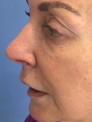Rhinoplasty: Case 21 - Rhinoplasty, Wilton, CT - Before