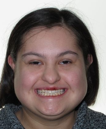 Alana: Alana - Before