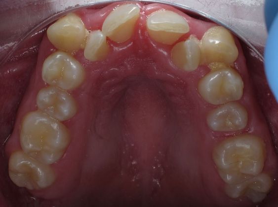 Alana: Alana - Before