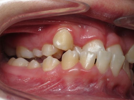 Alana: Alana - Before