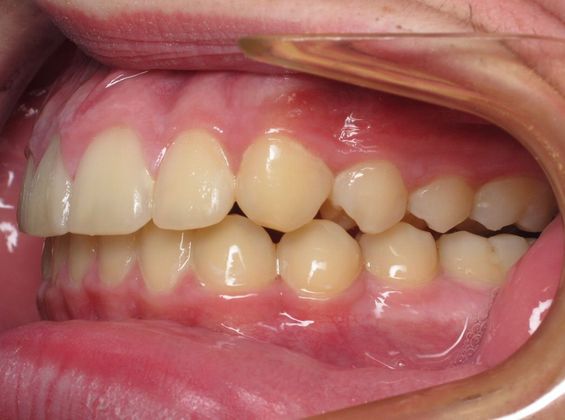 Parker: Parker - After