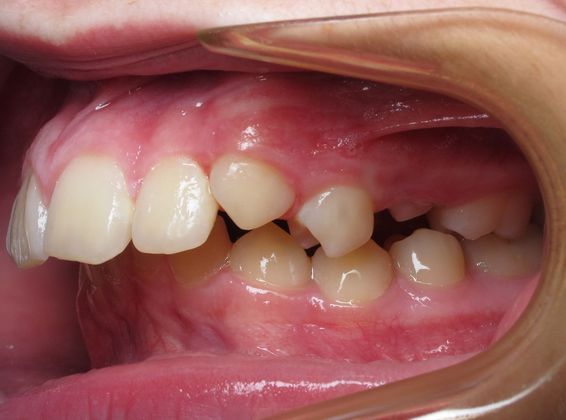 Parker: Parker - Before