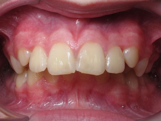 Parker Parker - Before