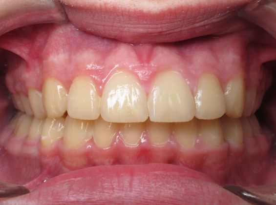 Parker Parker - After