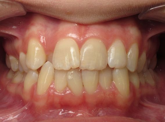 Louise: Louise - Before