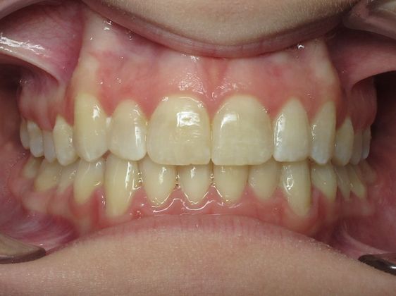 Louise: Louise - After