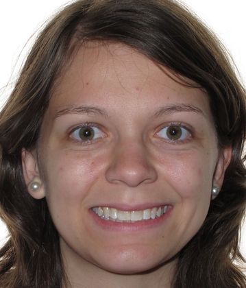 Louise: Louise - After