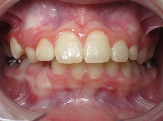 Hailey: Case 1 - After