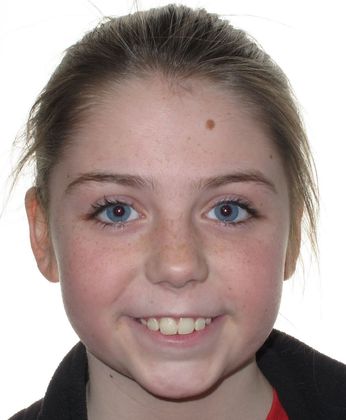 Hailey Case 1 - After