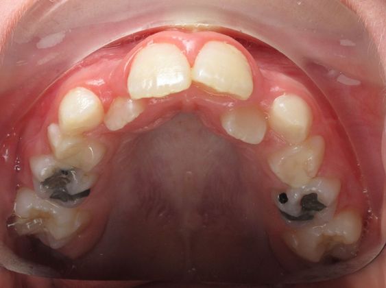 Hailey: Case 1 - After