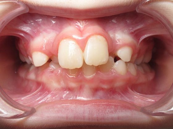 Hailey: Case 1 - Before