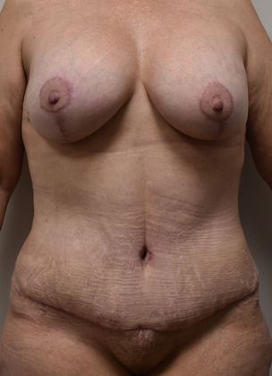 Mommy Makeover Case 141 - After