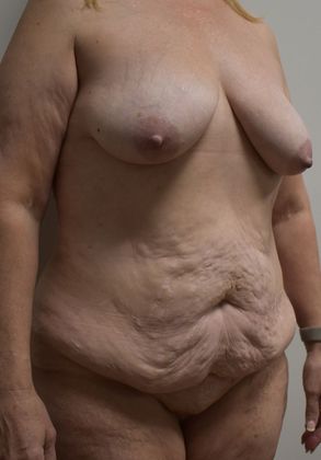 Mommy Makeover: Case 141 - Before