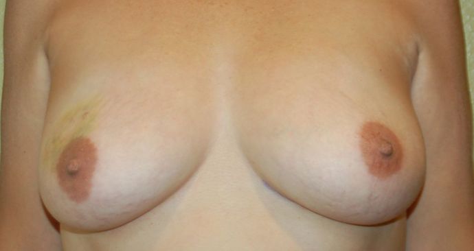 Breast Reconstruction Case 69 - Before
