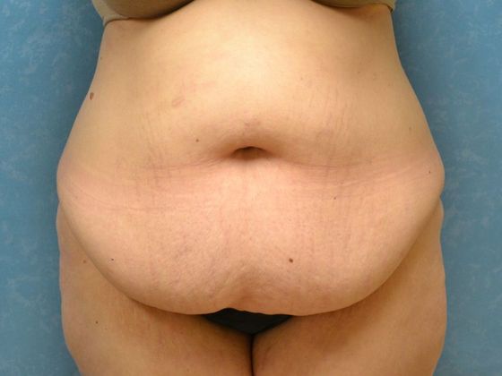 Bodylift Case 1525- Camden, MI - Before