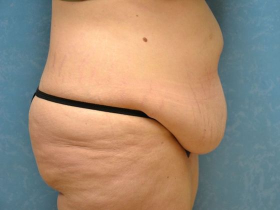 Bodylift: Case 1525- Camden, MI - Before