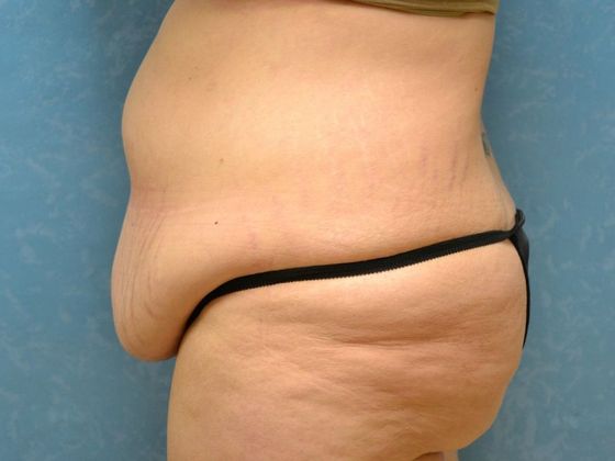 Bodylift: Case 1525- Camden, MI - Before
