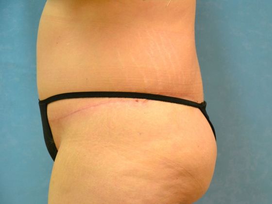 Bodylift: Case 1525- Camden, MI - After