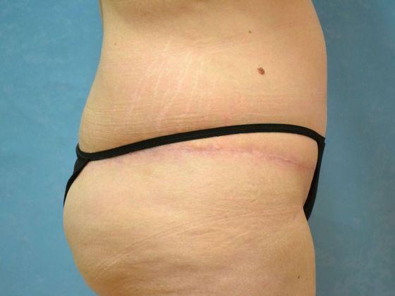 Bodylift: Case 1525- Camden, MI - After