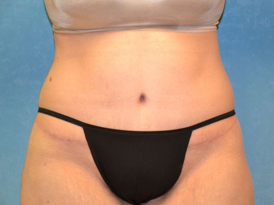 Bodylift Case 1525- Camden, MI - After