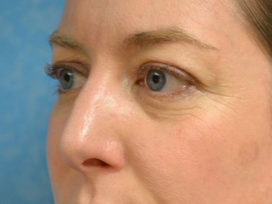 Rhinoplasty: Case 1409- Perrysburg, OH - Before