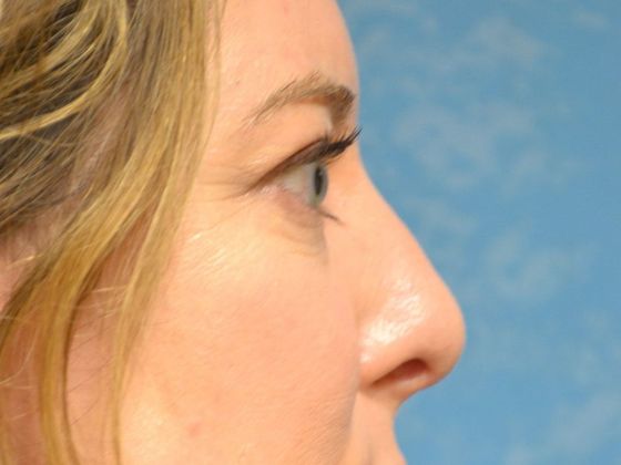 Rhinoplasty: Case 1409- Perrysburg, OH - After