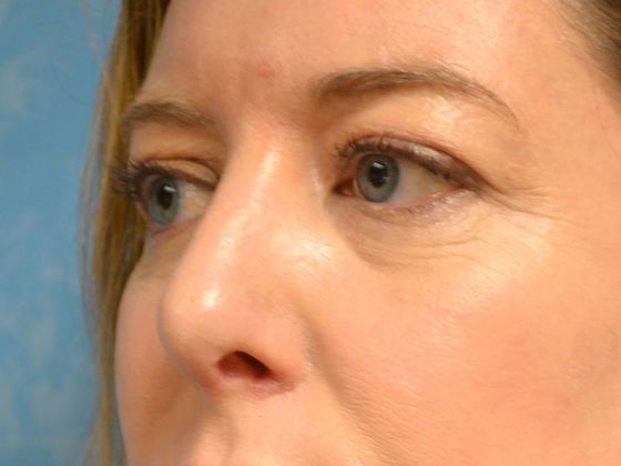 Rhinoplasty: Case 1409- Perrysburg, OH - After