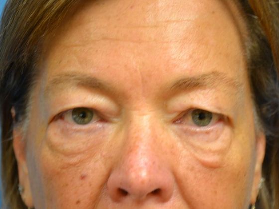 Eye Lift (Blepharoplasty) Case 1571- Toledo, OH - Before