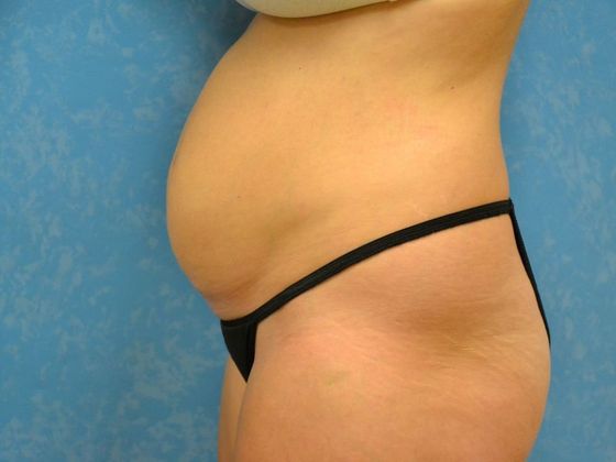 Tummy Tuck: Case 1678- Metamora, OH - Before