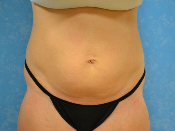 Tummy Tuck: Case 1678- Metamora, OH - Before