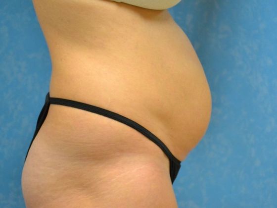 Tummy Tuck: Case 1678- Metamora, OH - Before