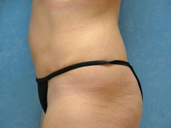 Tummy Tuck: Case 1678- Metamora, OH - After